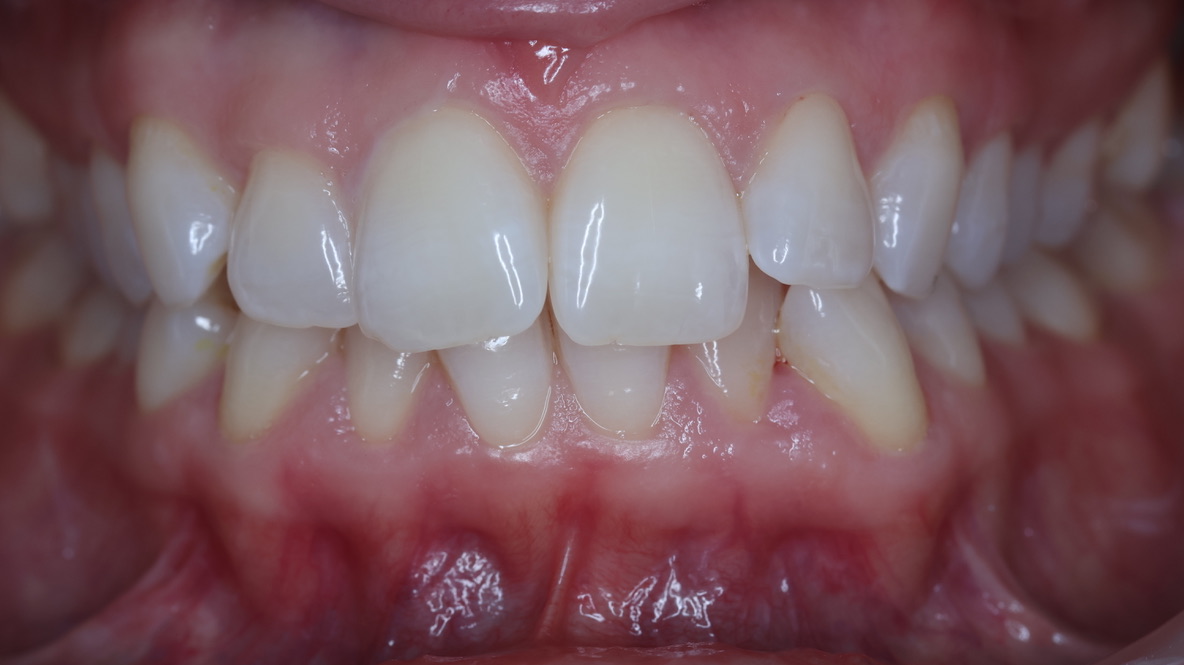 Before — F. Thompson, orthodontics