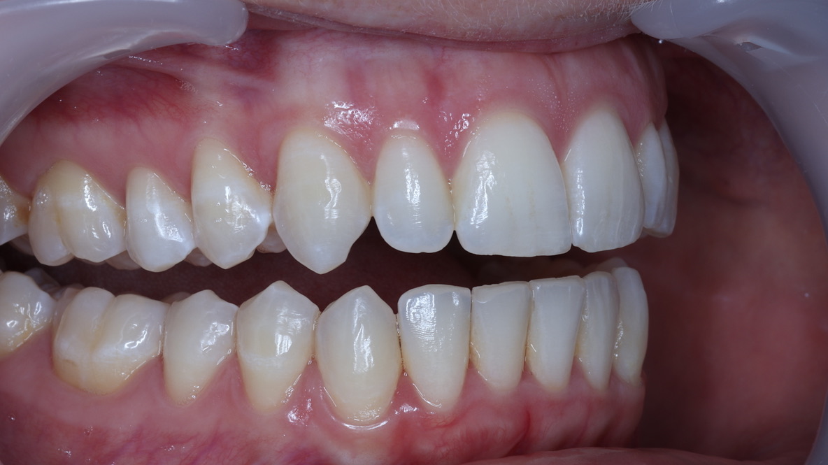 Before — India, orthodontics