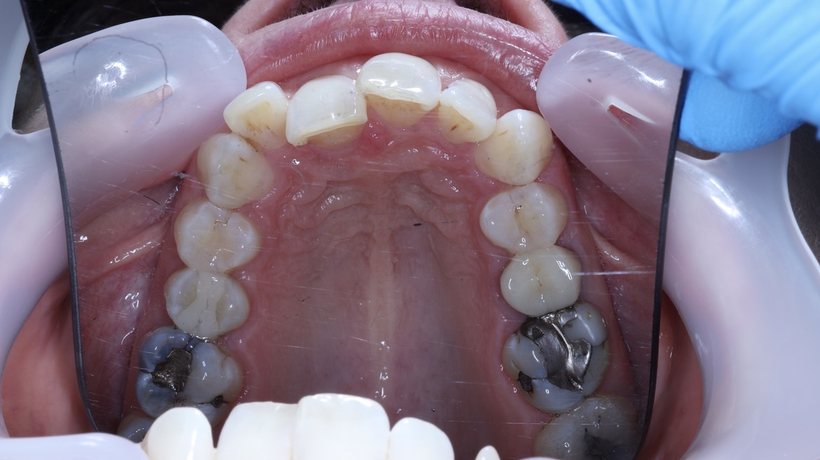 Before — Ruth, orthodontics