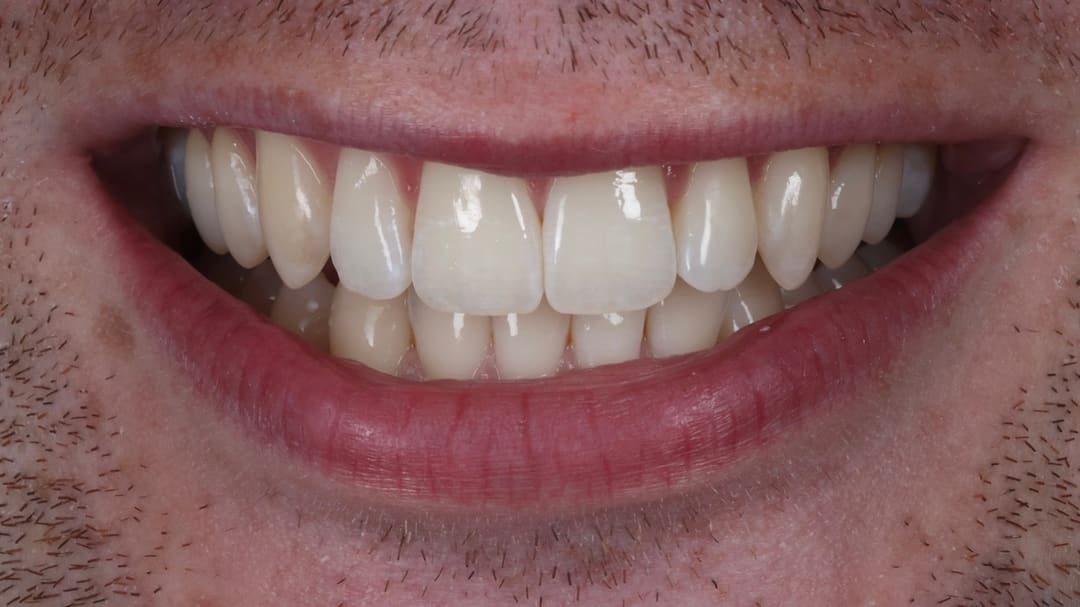 After — patient GA, orthodontics