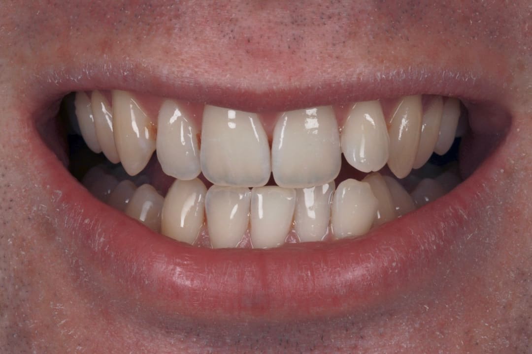 Before — patient GA, orthodontics
