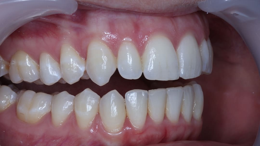 Before — patient I, orthodontics