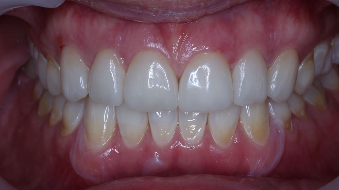 After — patient J, veneers