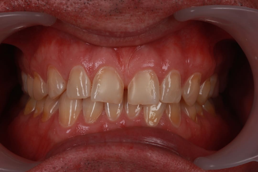 Before — patient J, veneers