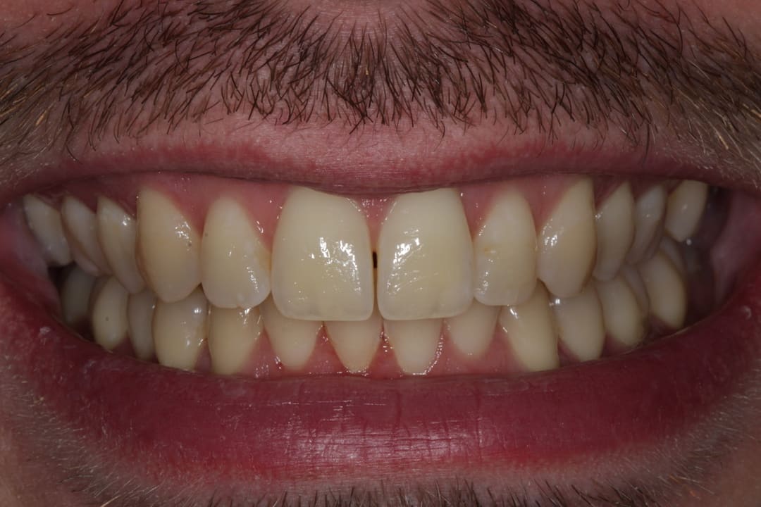 Before — patient J, whitening