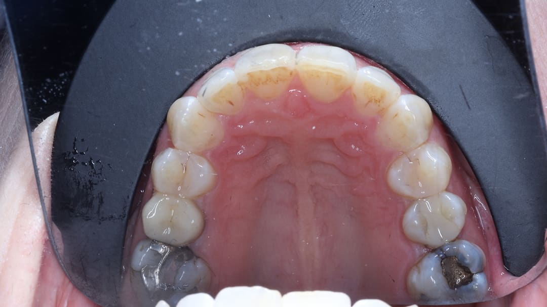 After — patient R, orthodontics