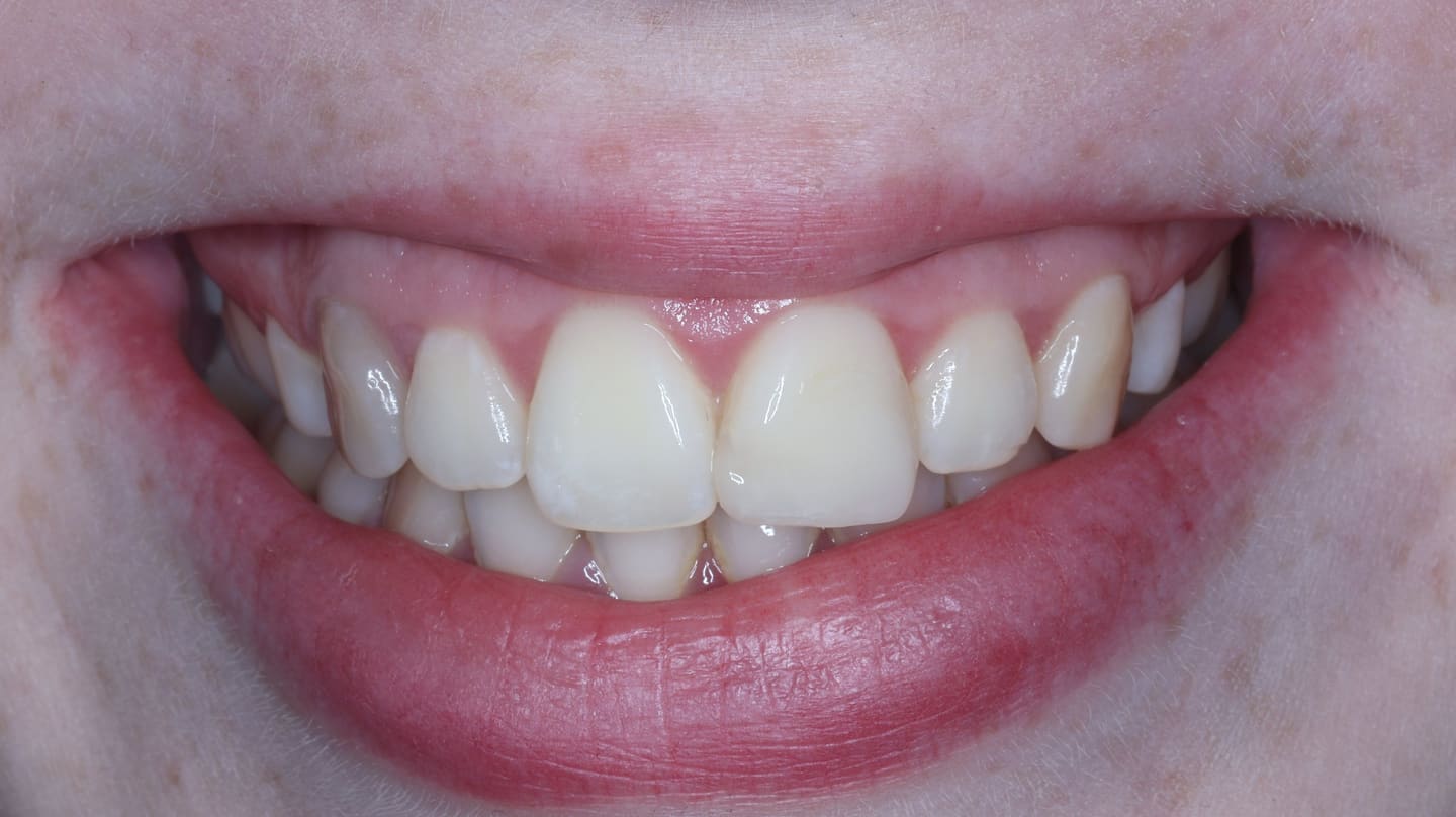 After — patient SC, trauma repair