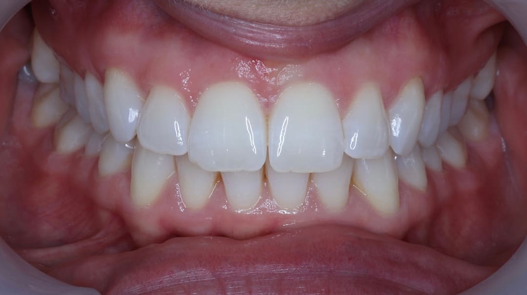 After — patient TF, orthodontics